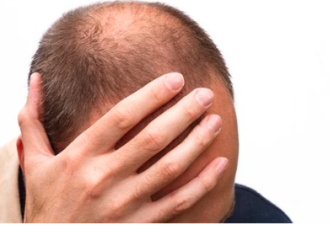 全球男性秃头最多的国家 美国第4 第一名竟是…