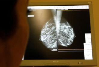 最新血液检测可以提早3年预测乳癌复发