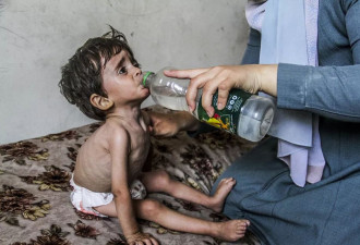 营养不良，加沙儿童在生死边缘挣扎