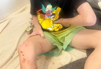 水上公园“鱼咬人”，8岁男孩右腿伤口凌乱