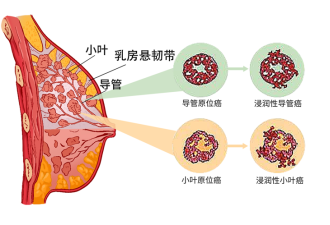 提醒：这9类人是乳腺癌高发人群