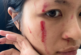 30岁华人女子在餐馆外遭无端袭击，被暴打满脸是血