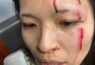 30岁华人女子在餐馆外遭无端袭击，被暴打满脸是血