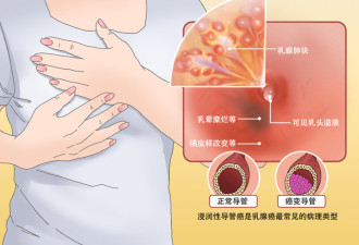 提醒：这9类人是乳腺癌高发人群