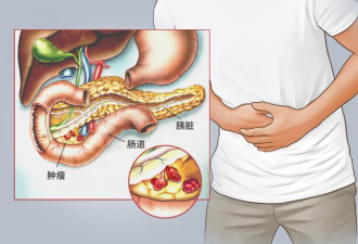 29岁小伙腰疼查出患癌 寿命最多剩半年