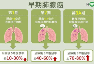 刘谦亲证患肺腺癌!专家提醒这几种结节应尽早手术