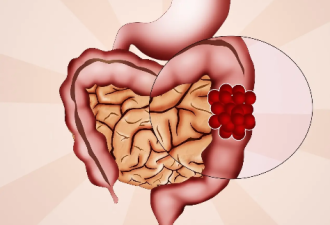 肠癌一发现就是晚期 出现4种症状要当心