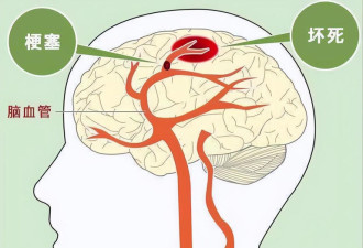 脑供血不足的6大信号 与这些疾病有关