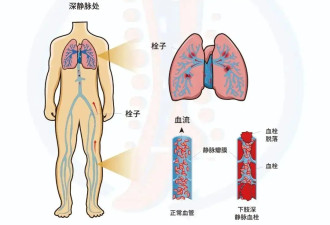 医生：血栓最爱攻击久坐不动的人