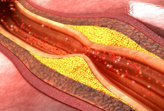 血管阻塞有救！奈米粒子注疗法可分解粥状斑块