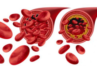血管阻塞有救！新方法分解粥状斑块
