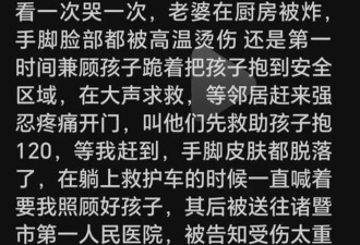 医生回应烧伤妈妈用钢丝球搓坏死皮肤:最佳治疗方案