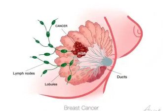 约四成乳腺癌发病与体脂超标相关