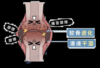 你天天都在做! 比跑步更伤膝盖的一个动作