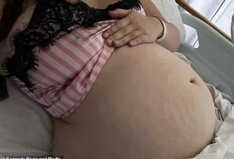 妹子8个月拉不出屎 最后用力过猛 肠子蹦了出来