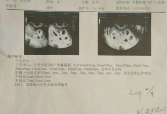 丈夫回应妻子怀九胞胎：决定减胎,可能会多次手术