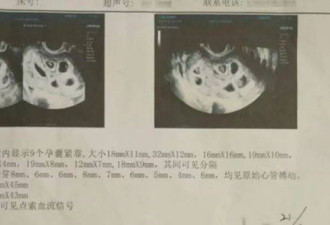 江西25岁女怀上“9胞胎” 产检现场傻眼