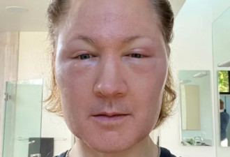 注射他人脂肪 欲重返18岁的美国富豪面目全非