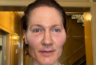 注射他人脂肪 欲重返18岁的美国富豪面目全非
