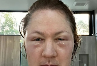注射他人脂肪 欲重返18岁的美国富豪面目全非