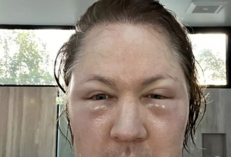 换血减龄的美亿万富翁整脸翻车：脸肿到眼睛消失