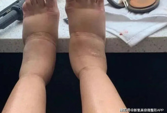130支玻尿酸填臀、600支丰胸，皮肤坏死、脚肿成馒头，太黑了！！！