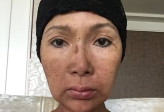 挺过口腔癌 58岁歌手张咪再罹舌癌 将切半边舌头