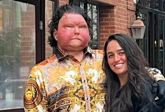 美国全脸移植男要结婚了 新面貌重生3年迎娶美妻