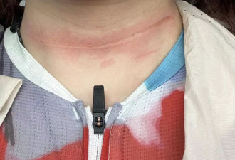女子参加骑行比赛 被风筝线“割喉”