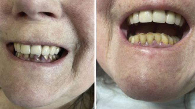 A 65-year-old woman with gum issues was diagnosed with scurvy. (Canadian Medical Association Journal)