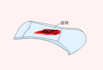 月经有血块正常吗？这是怎么了？