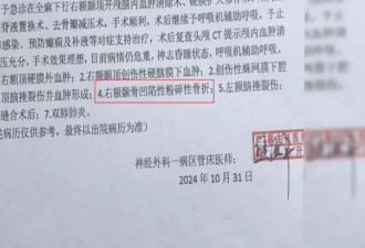 男子因不喝酒被朋友揍进ICU,头盖骨取出来10多块