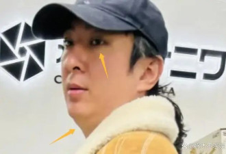 王思聪日本逛街 头发斑秃又胖了