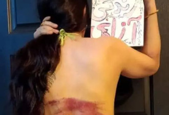 伊朗女子没戴头巾遭74下鞭刑，后背瘀伤醒目...