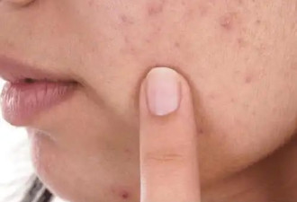 维A酸、克林霉素…长痘到底用什么才能不留疤？