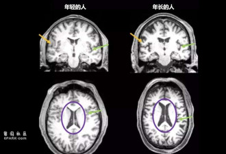 病一次老十年?德国大学科研发现:新冠影响大脑