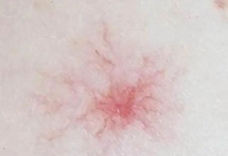 脸上长了蜘蛛痣 就是肝硬化吗？