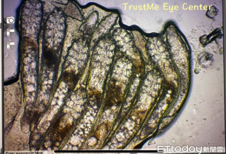 她好痒！ 医惊见一根毛“11只虫虫在爬”