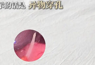 知名男主持紧急手术！“很丢人,希望大家别遇到”