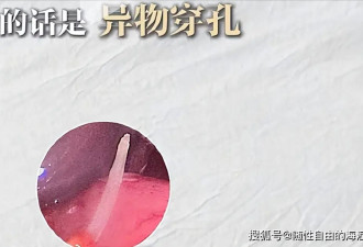 东方卫视知名主持人百克力惊险一刻：鱼刺穿胃扎到肝，生死一线之间