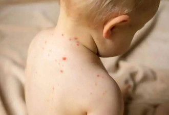 一种病毒两种疾病 家有老人小孩的要格外警惕