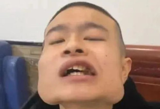 恐怖！河南青年嚼槟榔8年 瓜子脸变四方脸 如海绵宝宝：正在戒