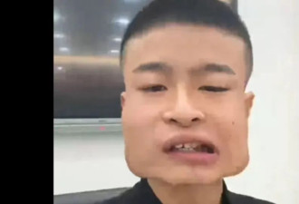 恐怖！河南青年嚼槟榔8年 瓜子脸变四方脸 如海绵宝宝：正在戒