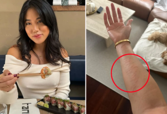 美国女子移居澳洲突然“肿得像球”!原因是这个