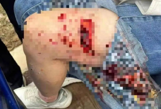 母女散步遭4条大型犬撕咬：狗主人系当地工程老板