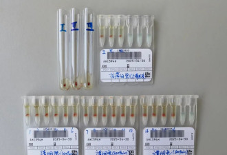 发现一例，极为罕见！这类人早做准备