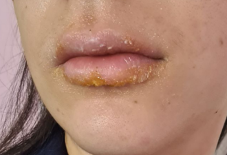 嘴唇干裂起皮老不好，别以为是缺水！可能是疾病