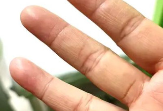 手变粗糙 竟然也是病？