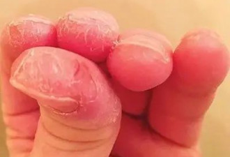 手变粗糙 竟然也是病？