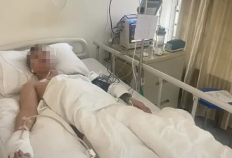 上班6天小伙误触辐射源面临截肢,辐射源有多可怕?